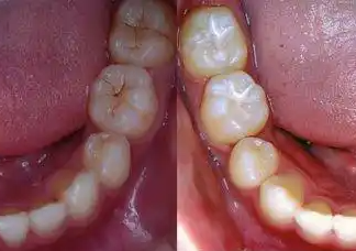 窩溝封閉、涂氟防蛀