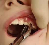 普通拔牙、阻生齒、牙周基礎(chǔ)*（刮治）