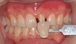 全瓷冠、美學(xué)樹(shù)脂修復(fù)