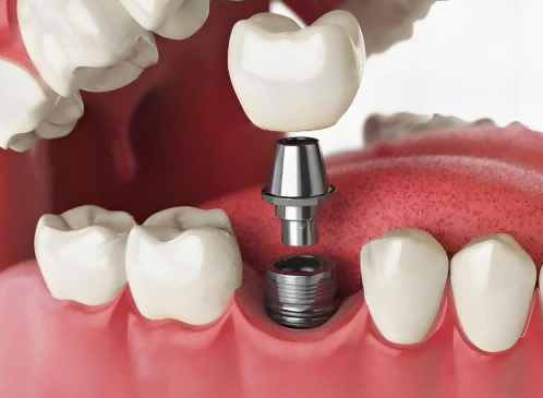 單顆/多顆種植牙、即刻種植