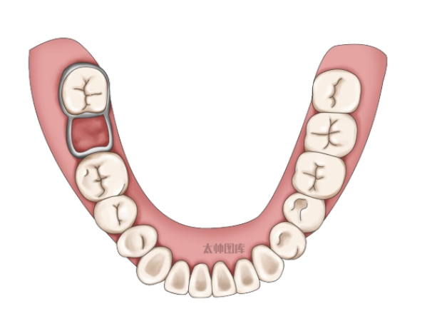 咬合誘導(dǎo)矯正、間隙保持器