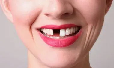 牙齒缺失，應(yīng)該選種植牙還是選烤瓷牙