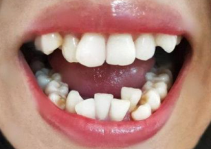 牙齒擁擠是什么原因造成的?